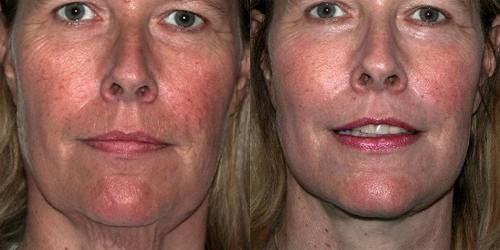 Fotorejuvenescimento